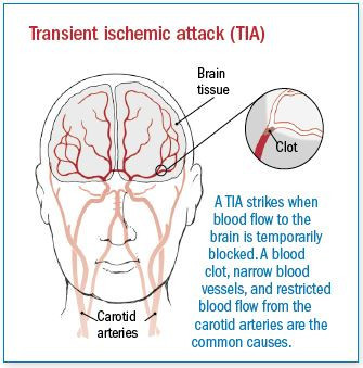 SERANGAN TRANSIENT ISCHEMIC (TIA) - Risiko dan Langkah Pencegahan 1 Ilustrasi serangan iskemia sementara (TIA) akibat aliran darah ke otak terhalang