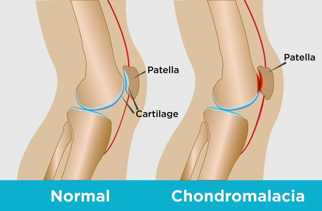 Chondromalacia Patella: Punca Sakit Bawah Tempurung Lutut & Rawatan Fisioterapi Paling Berkesan 25 DoctorsofOsteoChondromalaciaPatella.jpg
