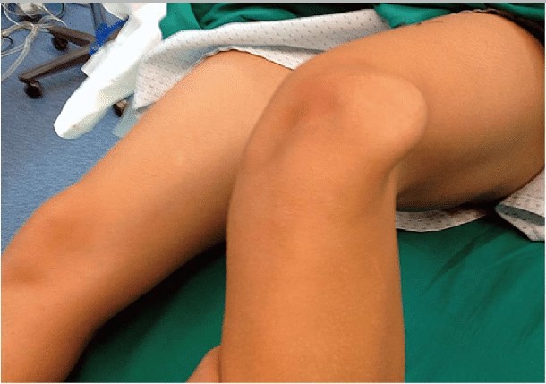 Patellar dislocation clinical