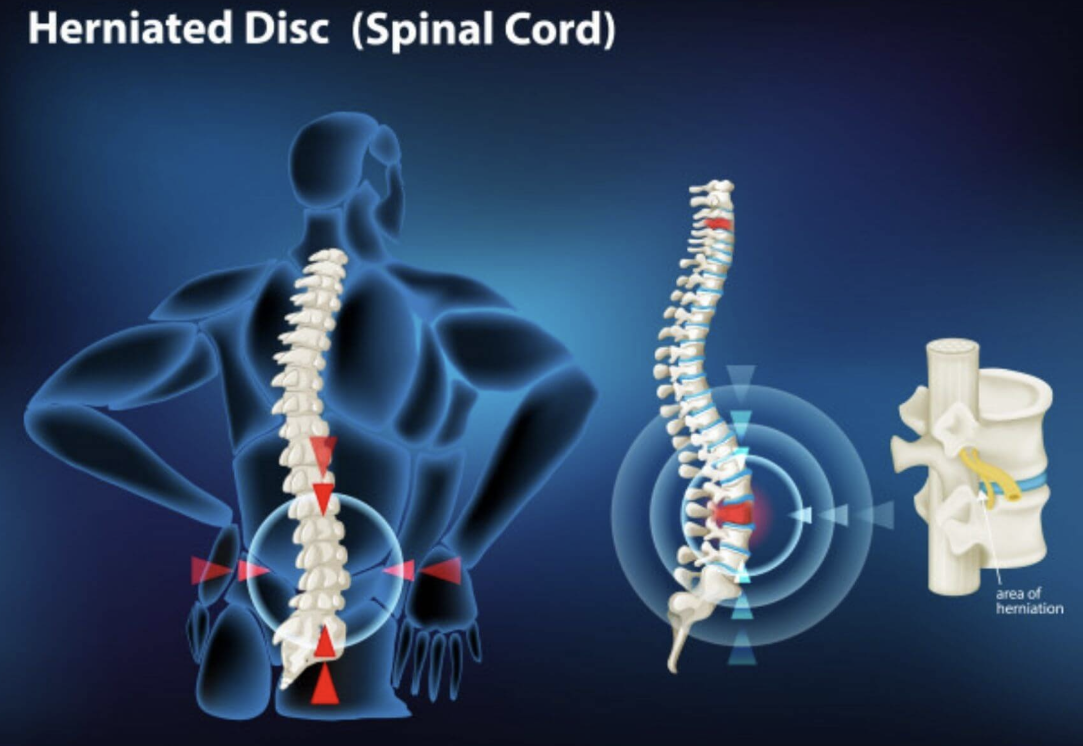 Ilustrasi herniated disc yang menekan saraf tulang belakang