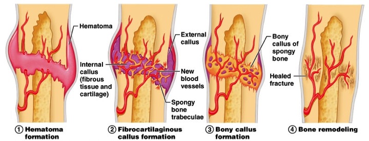 fractue healing