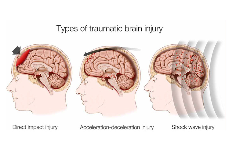KECEDERAAN OTAK (TRAUMATIC BRAIN INJURY) 9 TBI
