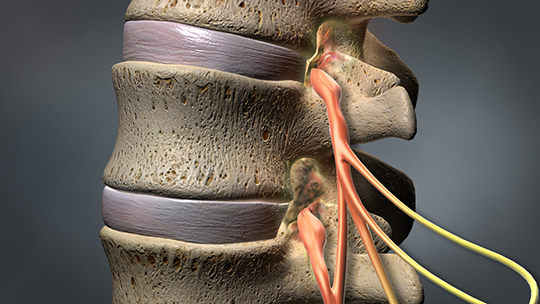 lumbar spinal stenosis