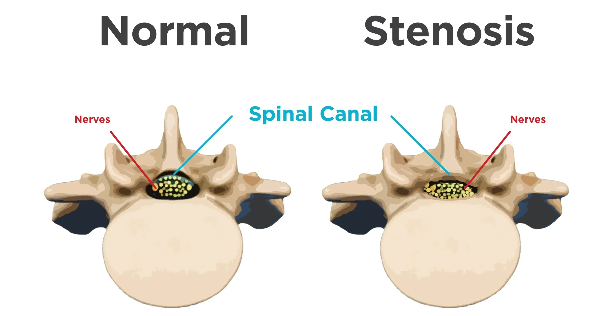 Stenosis Tulang Belakang Lumbar: Gejala dan Pilihan Rawatan 1 Ilustrasi perbandingan ruang salur tulang belakang biasa dan ruang yang menyempit