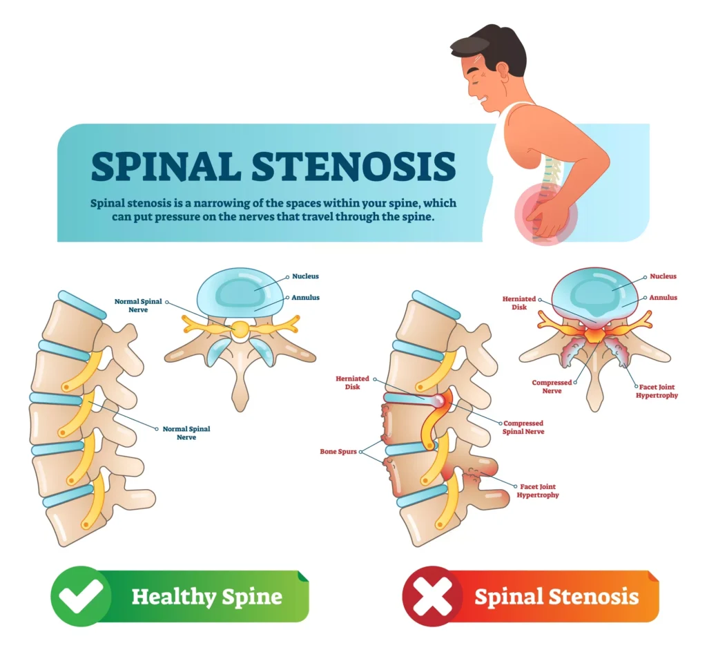 Diagnosis - Stenosis Lumbar 38 spinal stenosis grades and severity jpg webp