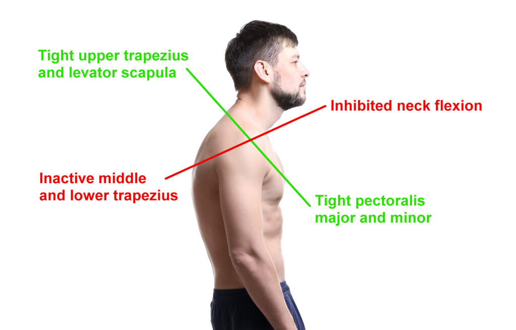 Upper crossed syndrome 3