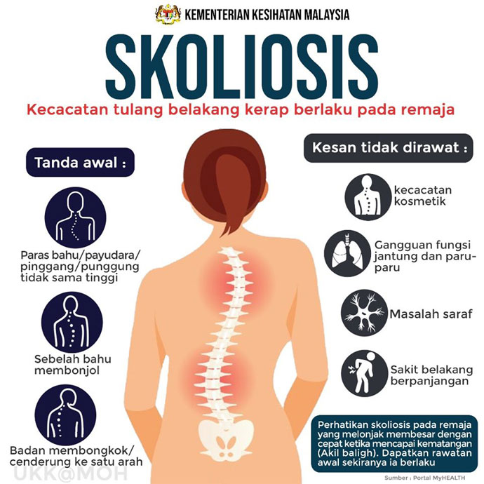 rawatan terbaik scoliosis