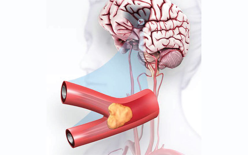 Stroke Kali Ke-2: Bahaya Ke? Tanda Amaran dan Langkah Seterusnya 7 Ilustrasi kesan stroke terhadap otak