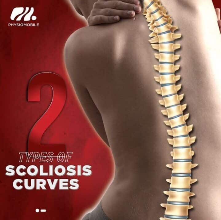 Scoliosis Treatment & Exercise You Should Try