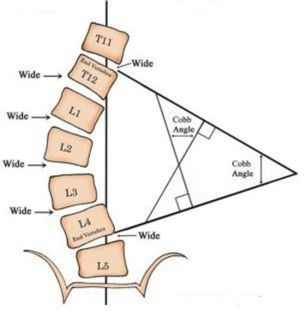 Manual method for measuring the Cobb angle available from http incolors