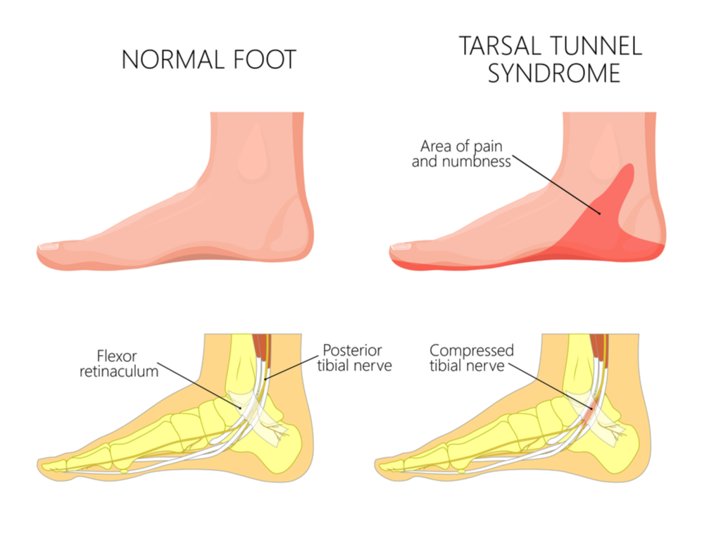 sakit tumit kaki