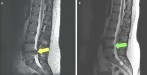 Slip Disc image