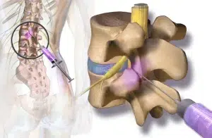 RF Injection Slip Disc