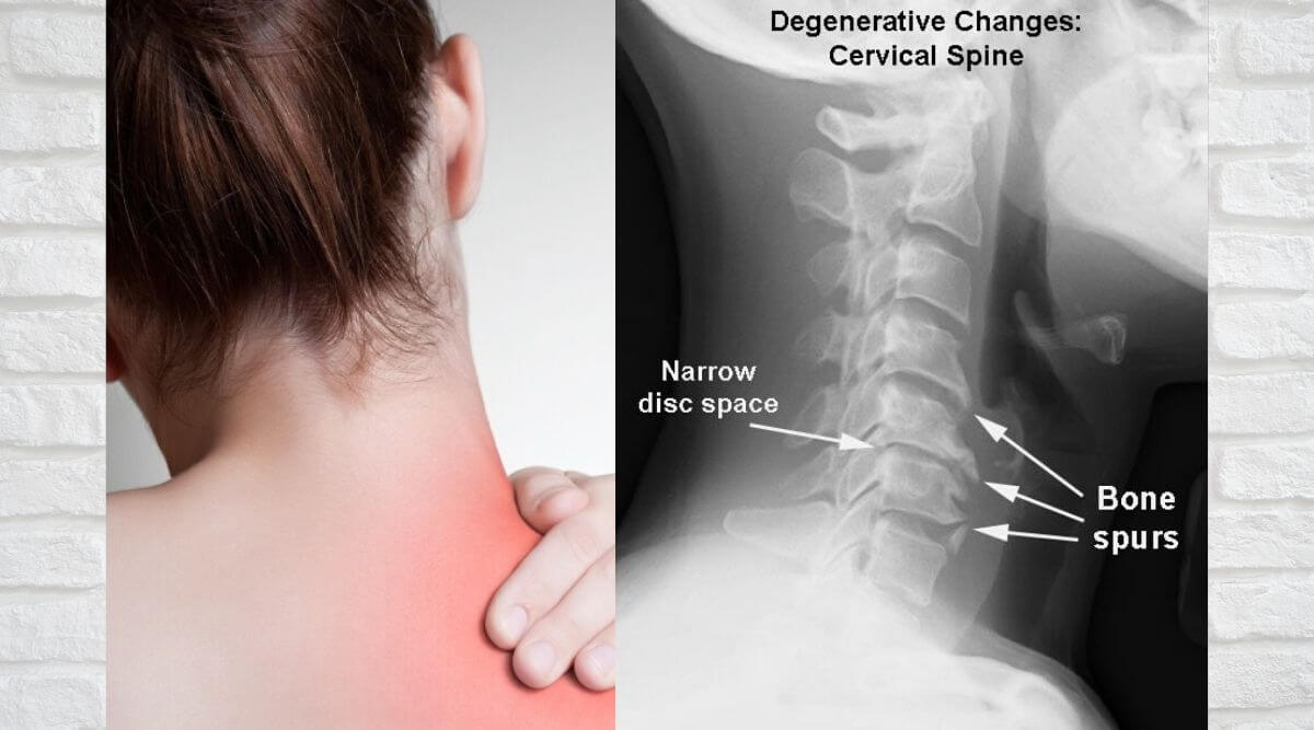 cervical spondy