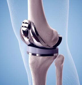 Physio sebelum selepas TKR