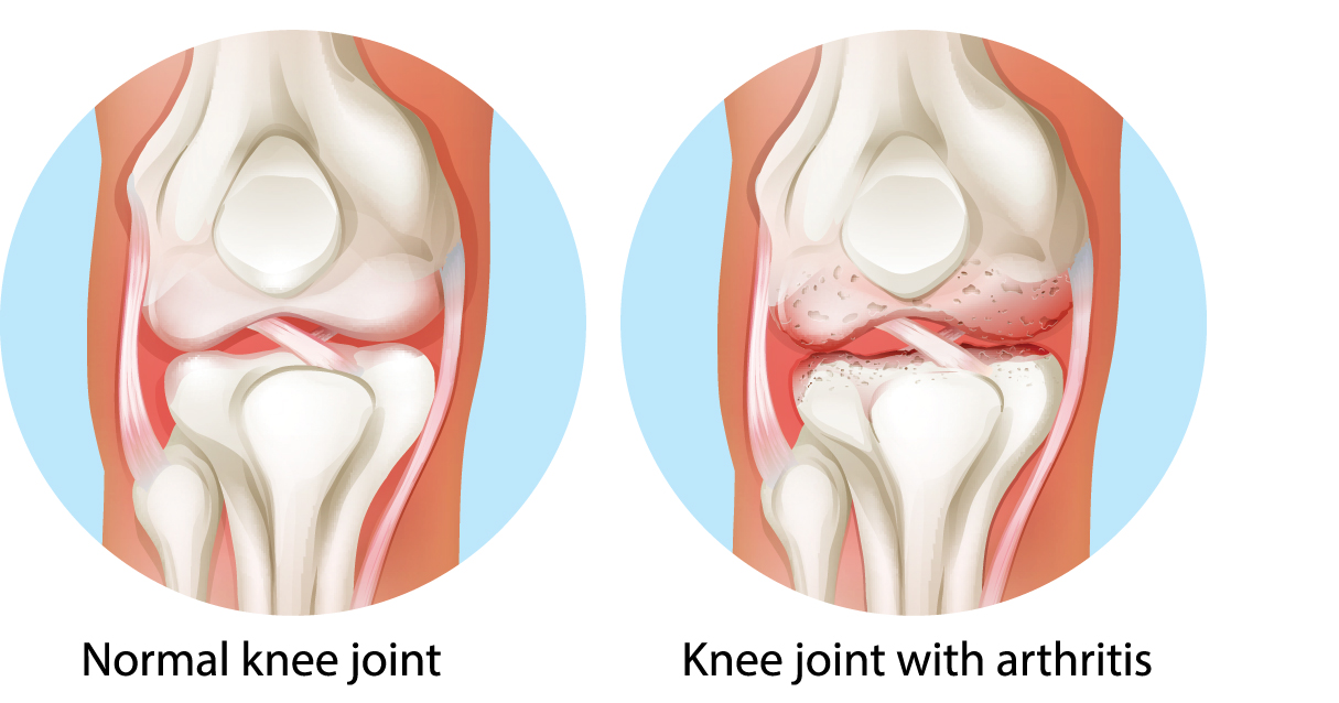Physiomobile - ACL lutut dan rehabilitasi sukan