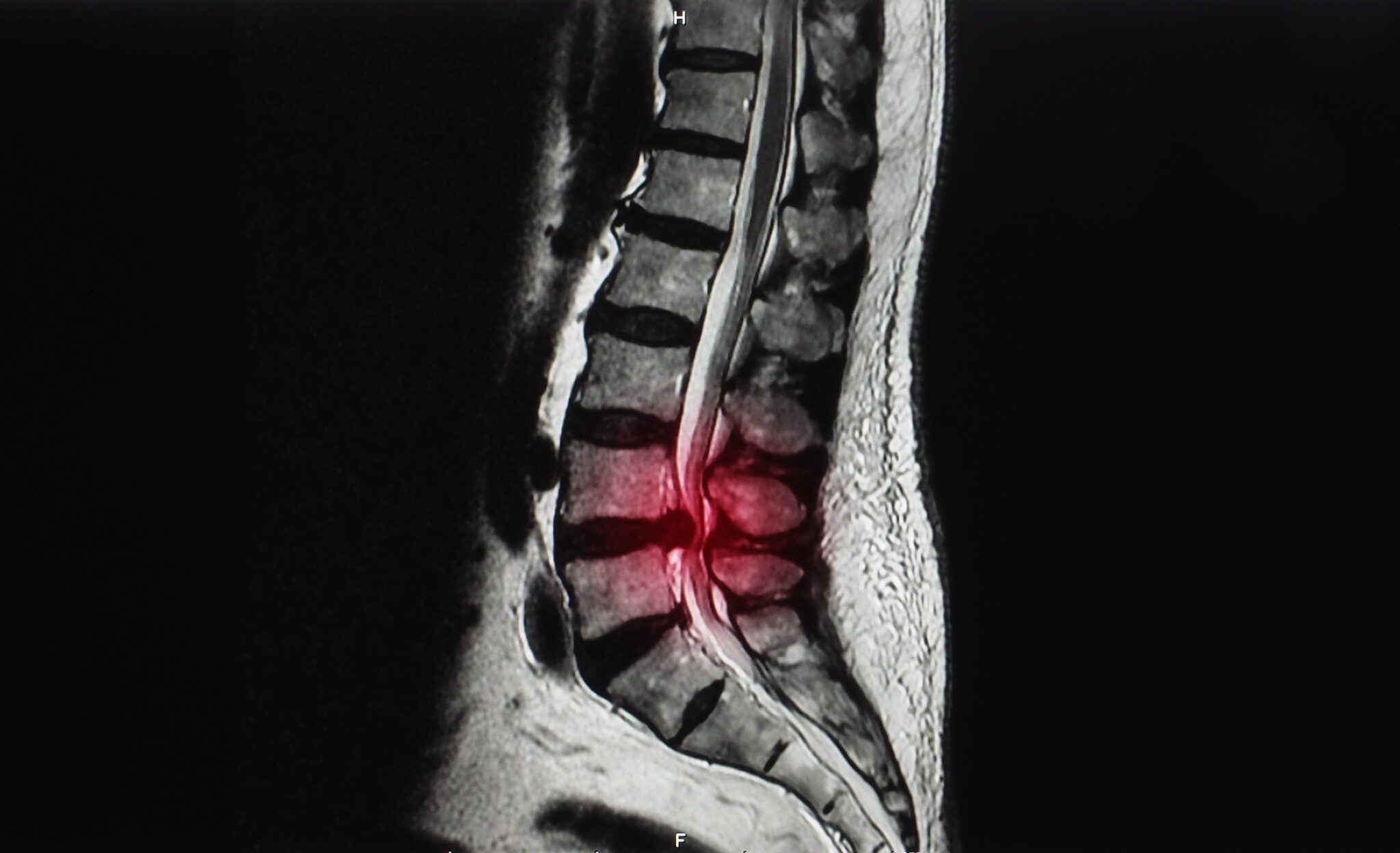 Physiotherapy for sciatica at home