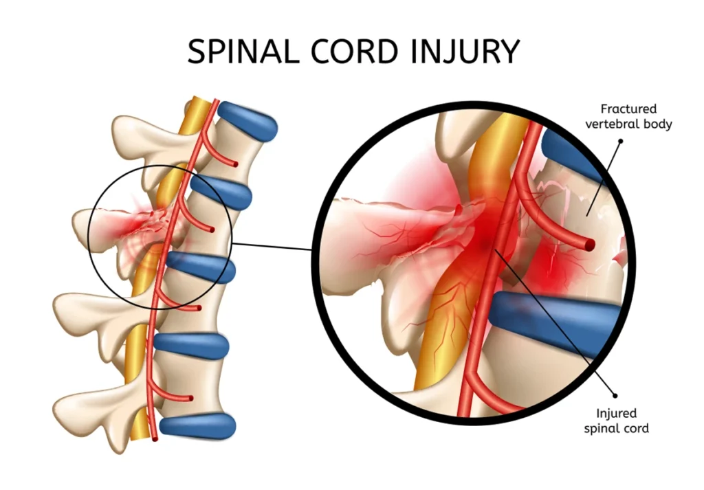 acute spinal cord injury