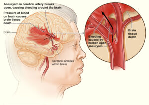 stroke pecah darah