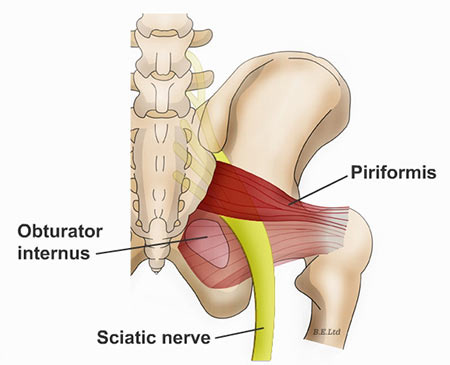 Physiomobile - sakit punggung dan piriformis syndrome