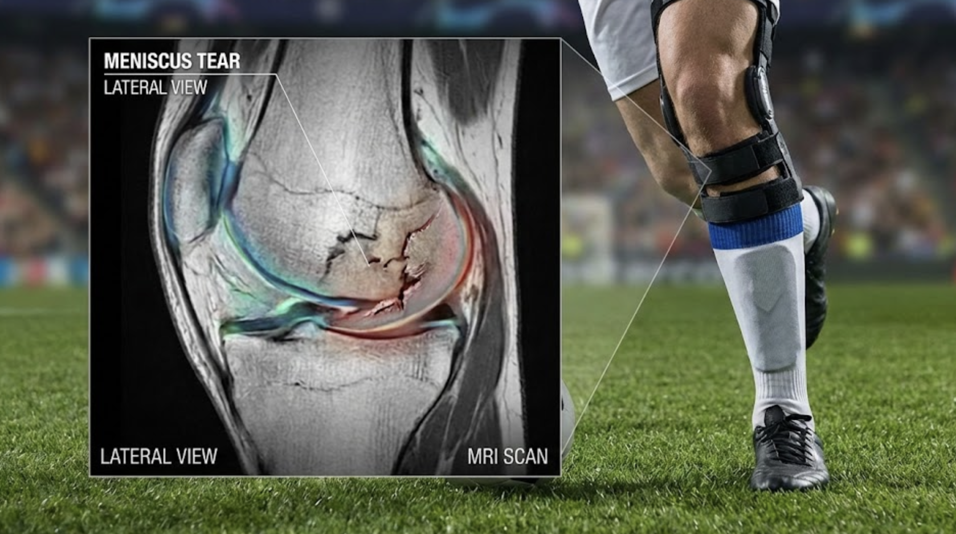 Tisu Lutut Koyak (Meniscus): Patut Operate atau Fisioterapi Sahaja?